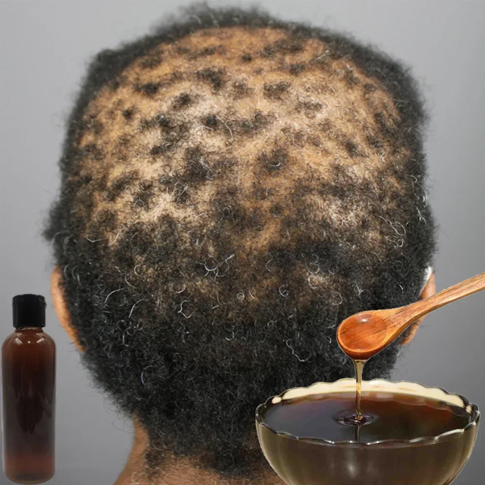 Africa Women Traction Alopecia – Hair Care Ginseng Bewertung und Preis